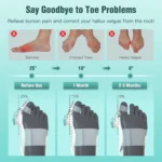 Orthèse hallux valgus de nuit