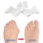 Orthèse hallux Valgus en Silicone, chevauchement des gros orteils