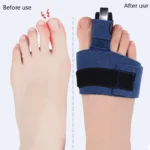 Orthèse hallux valgus pour fracture des orteils avec barre réglable en aluminium